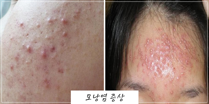 얼굴의 모낭염 증상이 가려워지면 확인해 주시기 바랍니다.