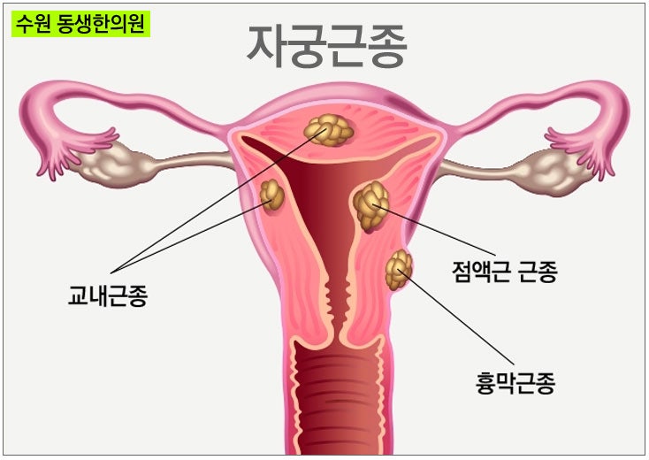 수원 자궁근종 매우 효과적인 한의학 치료법