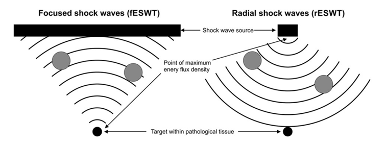 Extracorporeal ShockWave Therapy (ESWT, 체외충격파) : 네이버 블로그