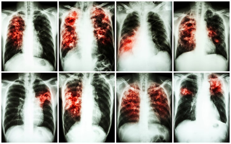폐섬유증 폐섬유화증 폐가 굳는다? 증상과 치료법은?