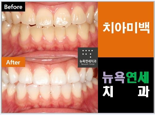 치아미백 종류 마다 효과가 다른 이유는 무엇일까요?