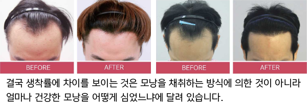 비절개 모발이식의 착상율 고려