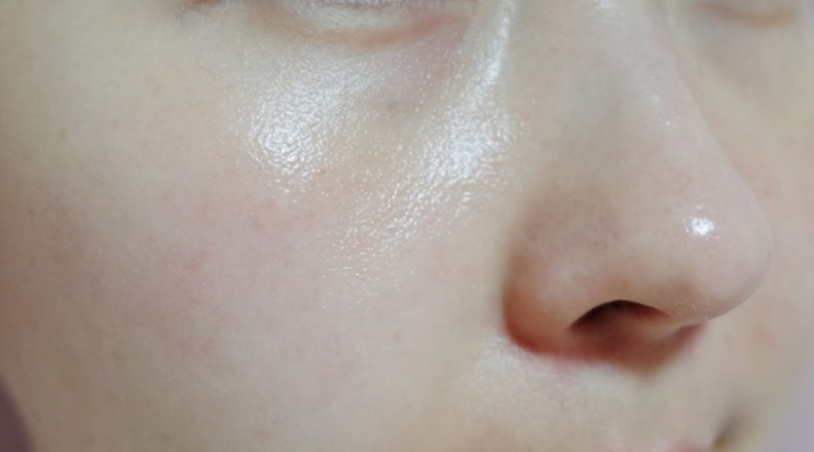  킬포어 모공관리기 코 블랙헤드 제거기 피지잡고 콕콕앰플로 관리중