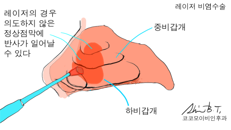  만성비염수술 , 많이 아픈가요?