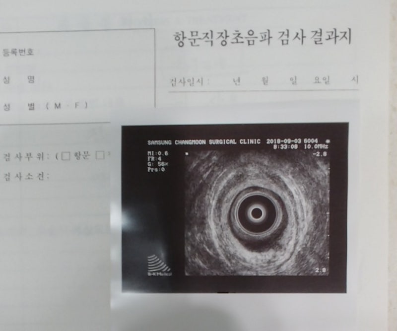 항문 농양 제거 수술 리얼 후기-1 (feat. 항문 농양의 습격) : 네이버 블로그 항문 농양 제거 수술 리얼 후기-1 (Feat. 항문 농양의 습격) : 네이버 블로그