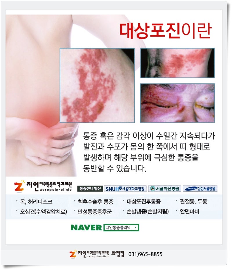 대상포진에 대해…