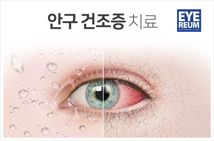 안구건조증, 메마른 눈을 촉촉하게 만드는 팁!
