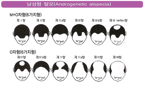 탈모의 종류 중 한가지인 남성형 탈모증 에대해 알아보도록 하자!!강서구 탈모