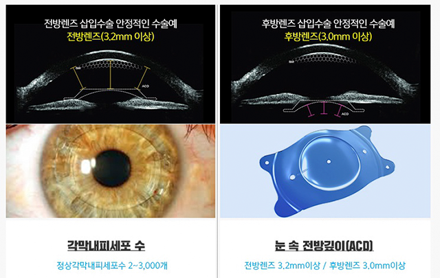 각막내피세포와 시력교정술 : 네이버 블로그