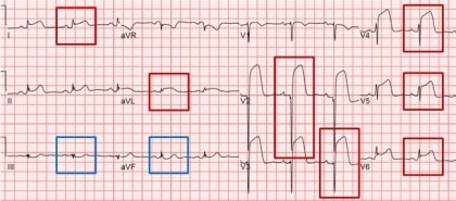 의학용어 MI : STEMI, NSTEMI 알아보기 5