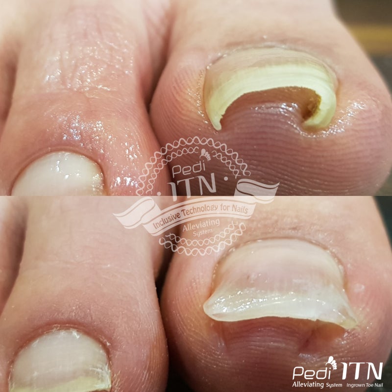 부산피부과 전문의 피부 파고드는 내성손톱 5