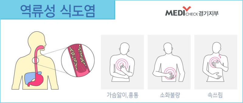 역류성식도염 가슴쓰림 원인과 해결방법