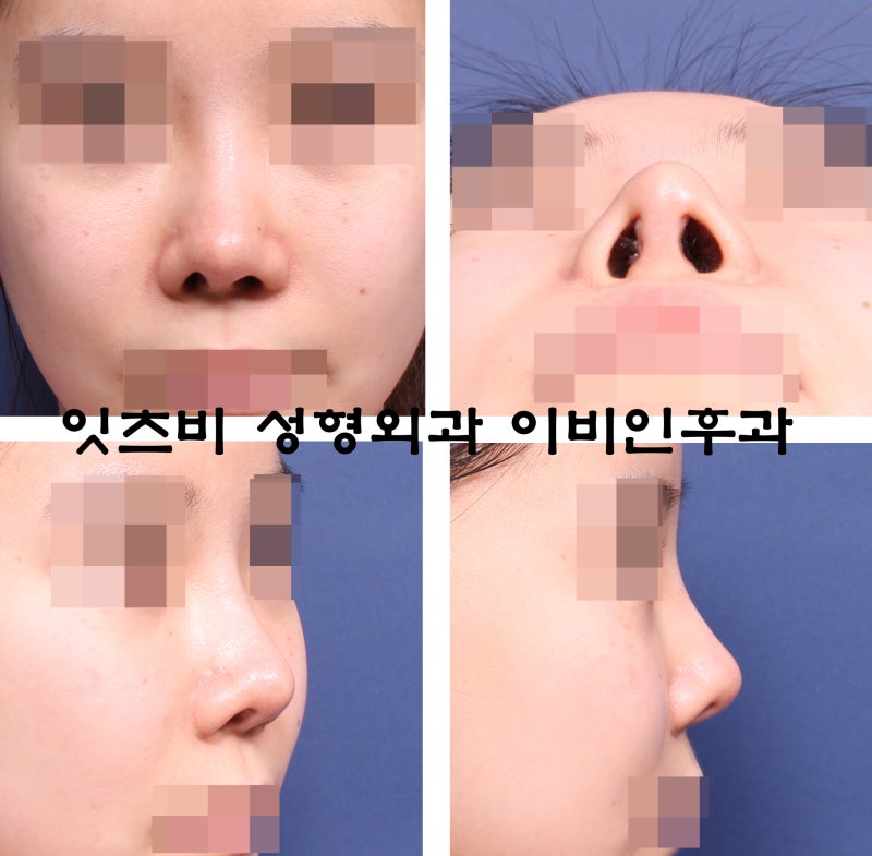 구축 코 + 들린 코 + 시작점 내리기 + 비중격 천공 막기 + 콧구멍 비대칭 교정 코 재수술(자가늑연골)