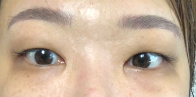 리얼 쌍수 후기 2 수술당일 / 광고아님 / 쌍꺼풀 수술 후기 / 쌍수 절개 후기 리얼 쌍수 후기 2 수술당일 / 광고아님 / 쌍꺼풀 수술 후기 / 쌍수 절개 후기