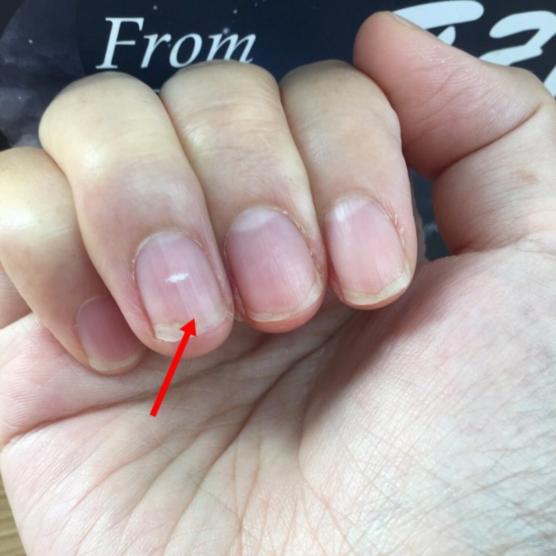 흑색종 손톱, 발톱 검은 줄 왜 생기는 걸까? 2