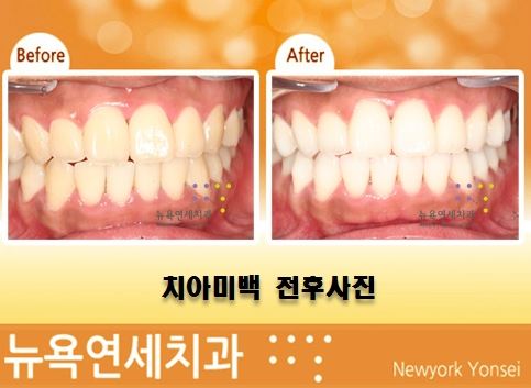 빠른 원데이 치아미백으로 하루 만에 치아미백을 완성하기.