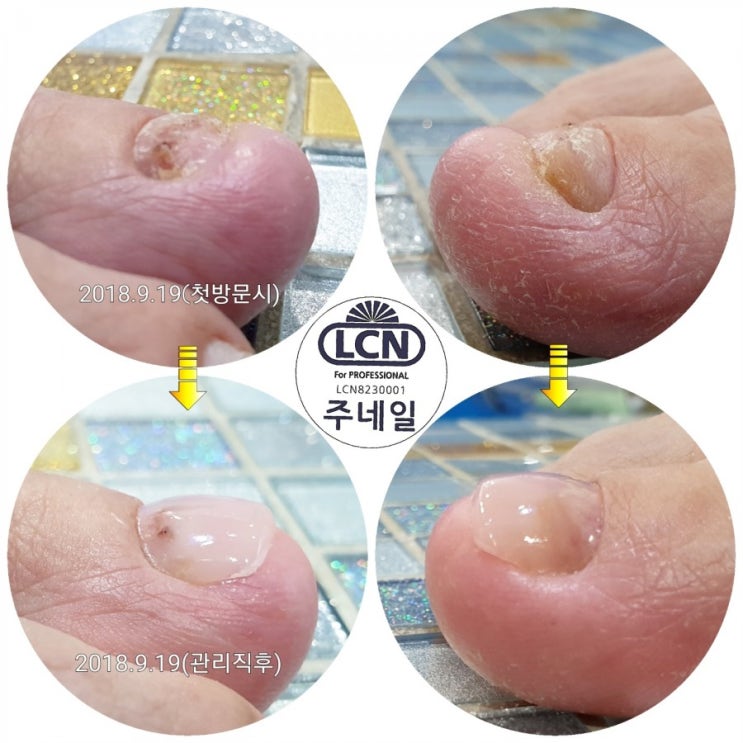 변형된발톱때문에정말고민입니다/분당용인수원수지보정동백죽전동/주네일/파고드는문제성발톱전문네일샵 변형된발톱때문에정말고민입니다/분당용인수원수지보정동백죽전동/주네일/파고드는문제성발톱전문네일샵