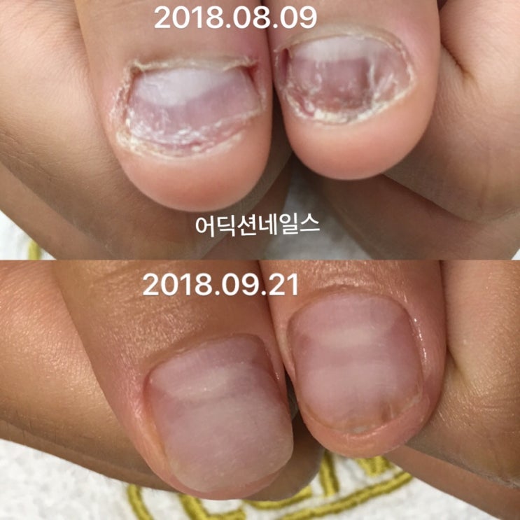  물어뜯는 손톱교정 중간결과