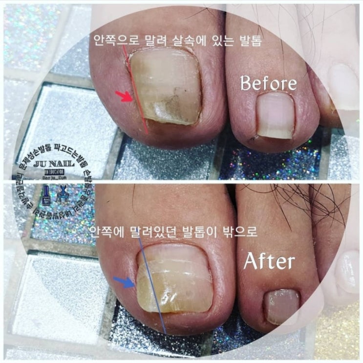 눈으로보고도믿을수없는파고든발톱1회관리후/분당용인수원수지보정동백죽전동/주네일/내향성발톱 눈으로보고도믿을수없는파고든발톱1회관리후/분당용인수원수지보정동백죽전동/주네일/내향성발톱