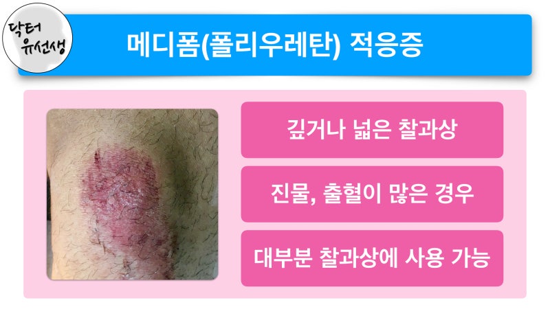 찰과상, 상처 드레싱, 듀오덤, 메디폼 : 네이버 블로그 찰과상, 상처 드레싱, 듀오덤, 메디폼 : 네이버 블로그