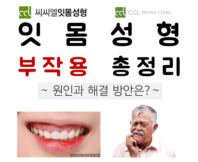 잇몸성형부작용, 거미스마일교정, 레이저미용치과