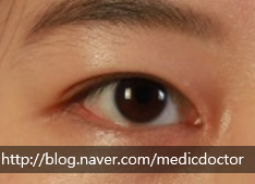인아웃라인 쌍꺼풀 인라인 쌍꺼풀 아웃라인 쌍꺼풀 만들기