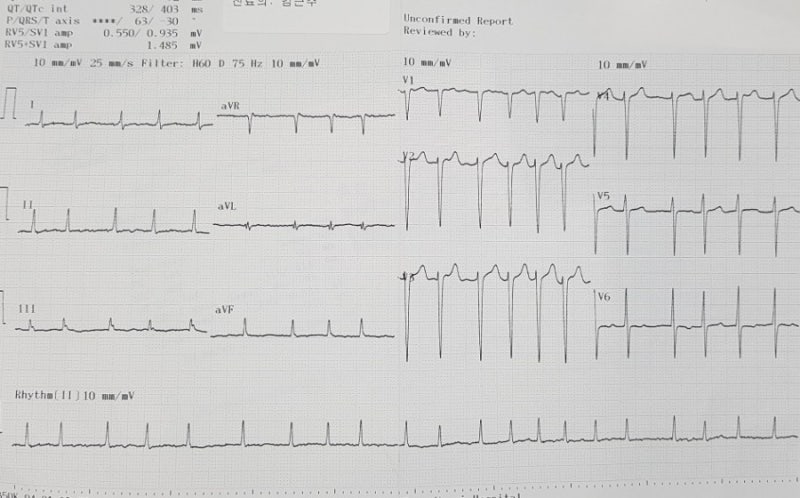 PSVT 라고 전원된 AFib 환자 : 네이버 블로그