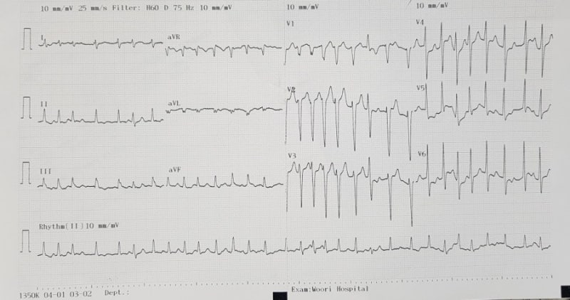 PSVT 라고 전원된 AFib 환자 : 네이버 블로그