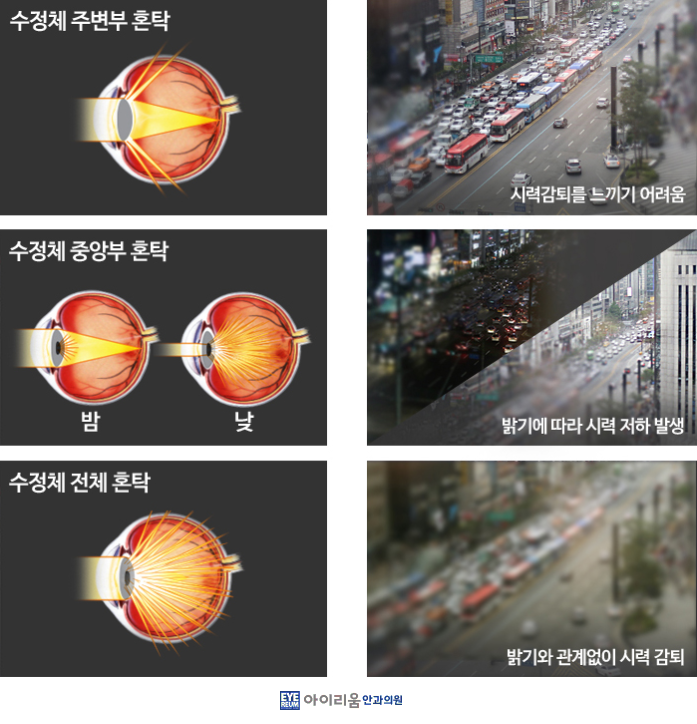 혹시 나도 백내장?! -노안 백내장 구별법-