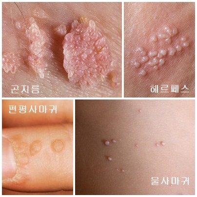 곤경 증상의 원인으로 HPV만을 생각하고 계십니까?