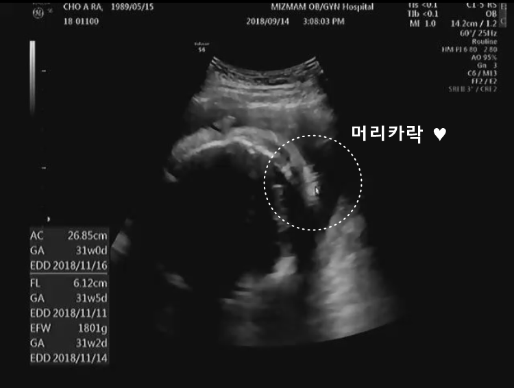 (임신 29주) 자궁수축증상 및 백일해 주사 + 아기체중 6