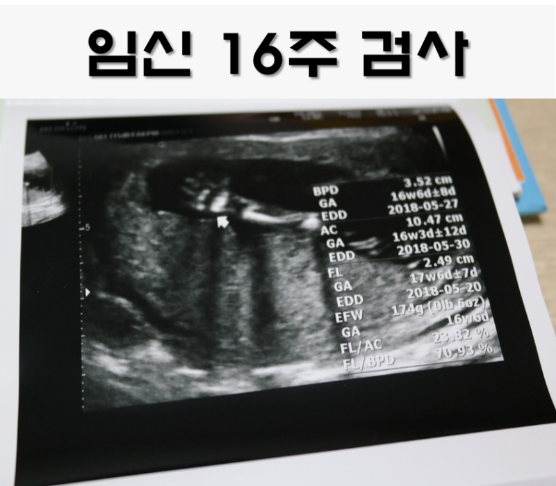 임신16주1일 2차 기형아 검사:취약X증후군, 산전 AFP검사