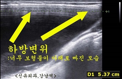 겨드랑이포트까지 제거하고 보형물교체한 가슴성형재수술<--밑선찝기도