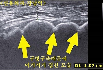 구형구축온 가슴보형물제거하며 처진가슴올리는 거상술 전후사진