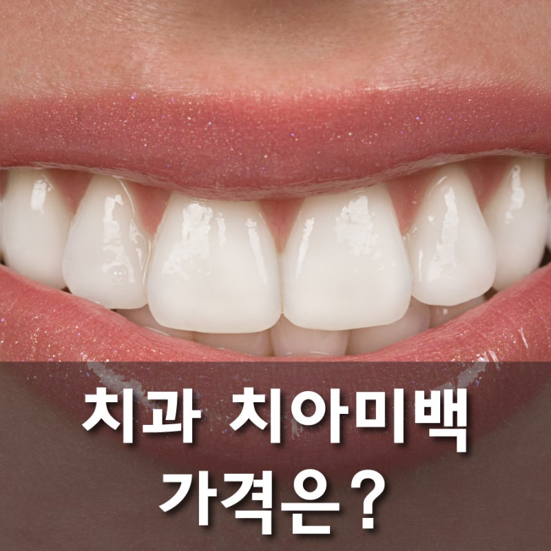 치과 치아미백가격 효과 있을까 - A3