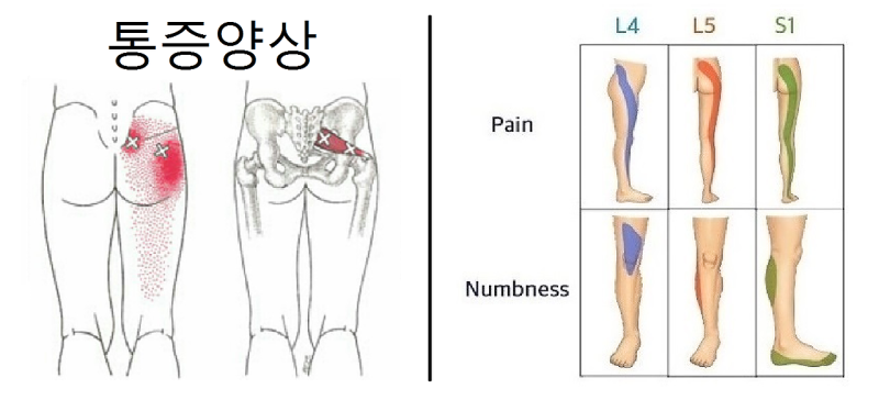 좌골신경통 치료방법 다리가 저려요 설명 : 네이버 블로그