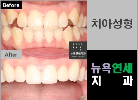  보기 좋지 않은 덧니를 치아성형하여 가지런하게 만들 수 있습니다.