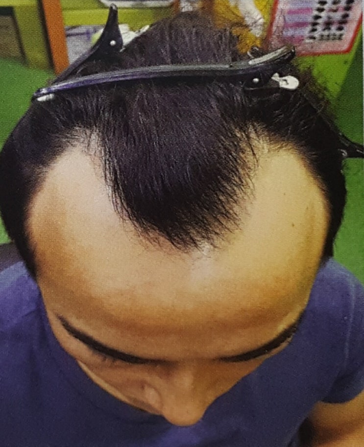  증모ㆍ김호증모ㆍ오늘은 누드증모의 대해 알아볼까요?