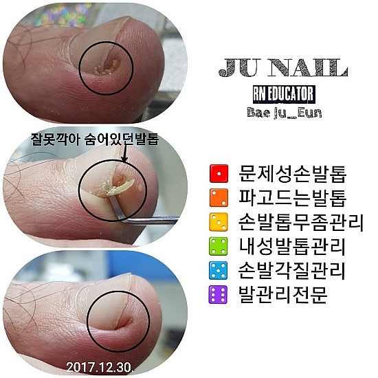 잘못깍은발톱/분당용인수원수지동백보정죽전동/주네일/파고드는발톱 