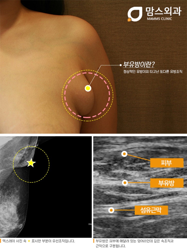 복부 지방 제거 비용 겨드랑이 덩어리 원인 및 통증 치료 병원 선택 비교 5