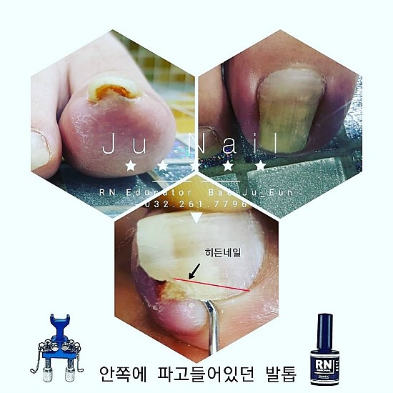염증발톱의원인/분당용인수원수지보정죽전동/주네일/파고드는발톱 염증발톱의원인/분당용인수원수지보정죽전동/주네일/파고드는발톱