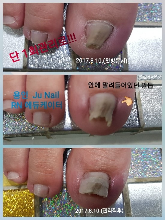 꼬깔모양발톱/분당용인수원수지보정죽전동/주네일/파고드는발톱 꼬깔모양발톱/분당용인수원수지보정죽전동/주네일/파고드는발톱