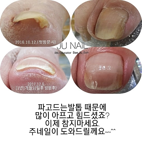 1년후/분당용인수원수지보정죽전동/주네일/파고드는발톱 1년후/분당용인수원수지보정죽전동/주네일/파고드는발톱