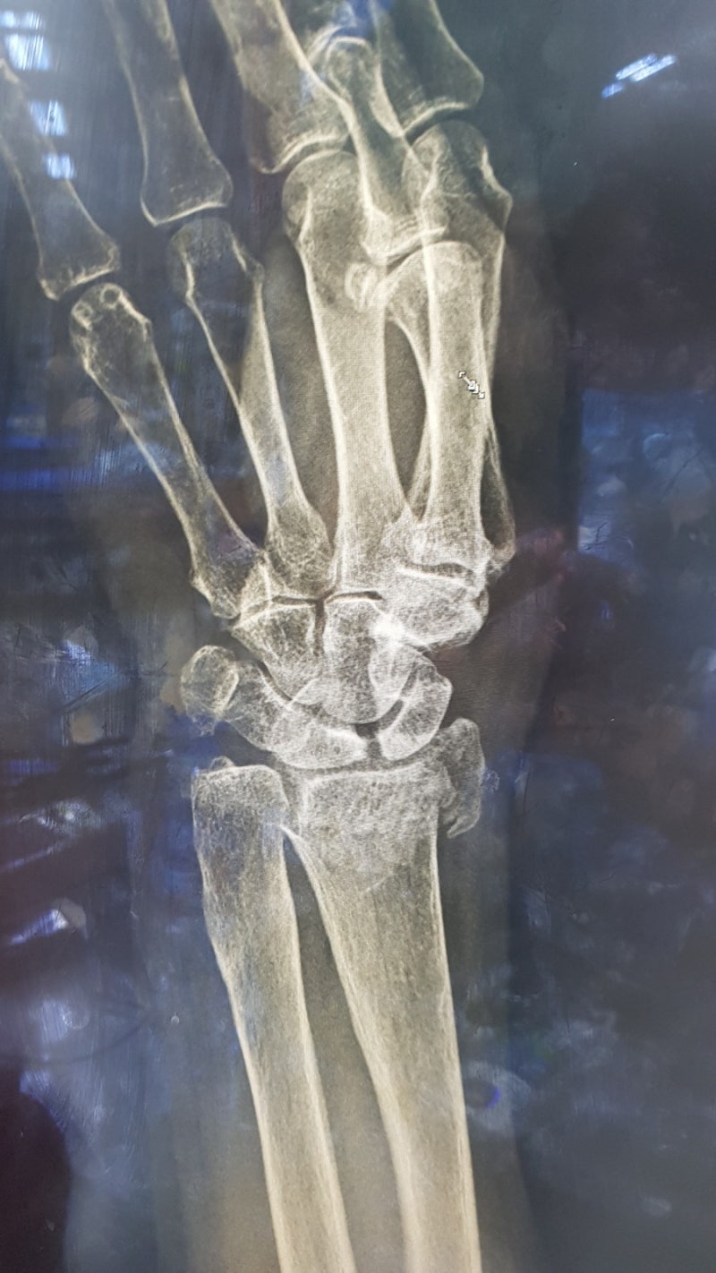closed reduction of Colles fracture : 네이버 블로그