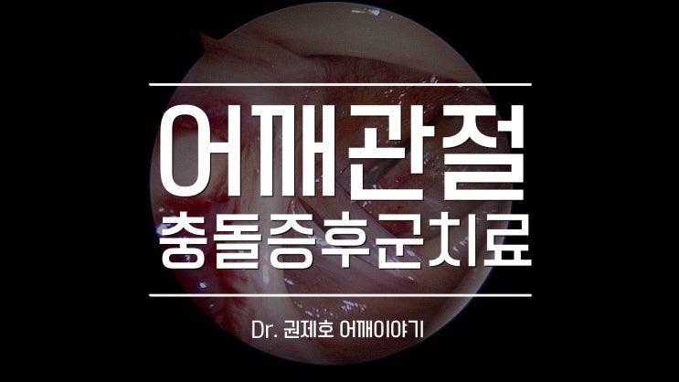  견관절충돌증후군 impingement 회전근개가 끊어지기 전에
