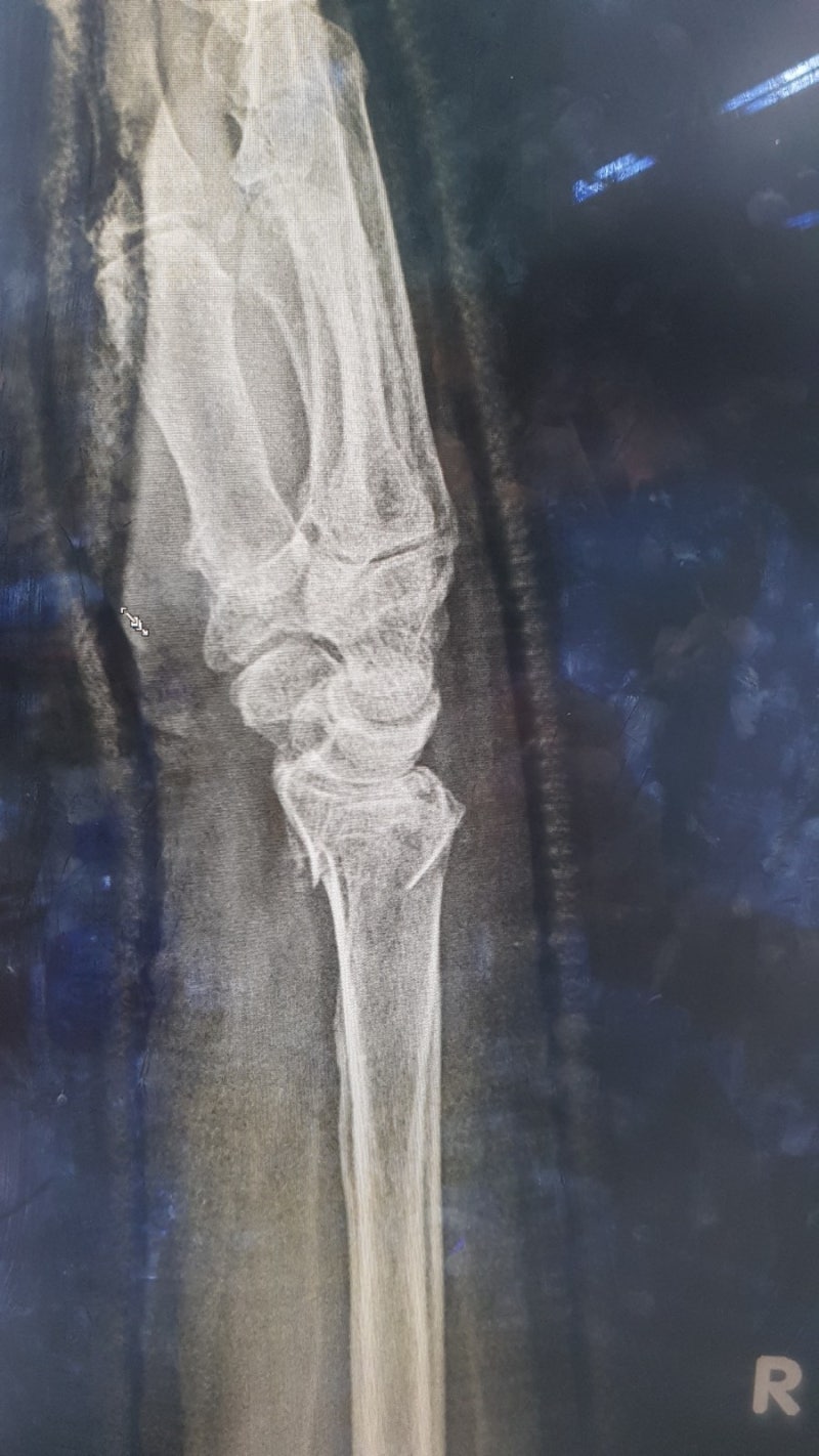 closed reduction of Colles fracture : 네이버 블로그