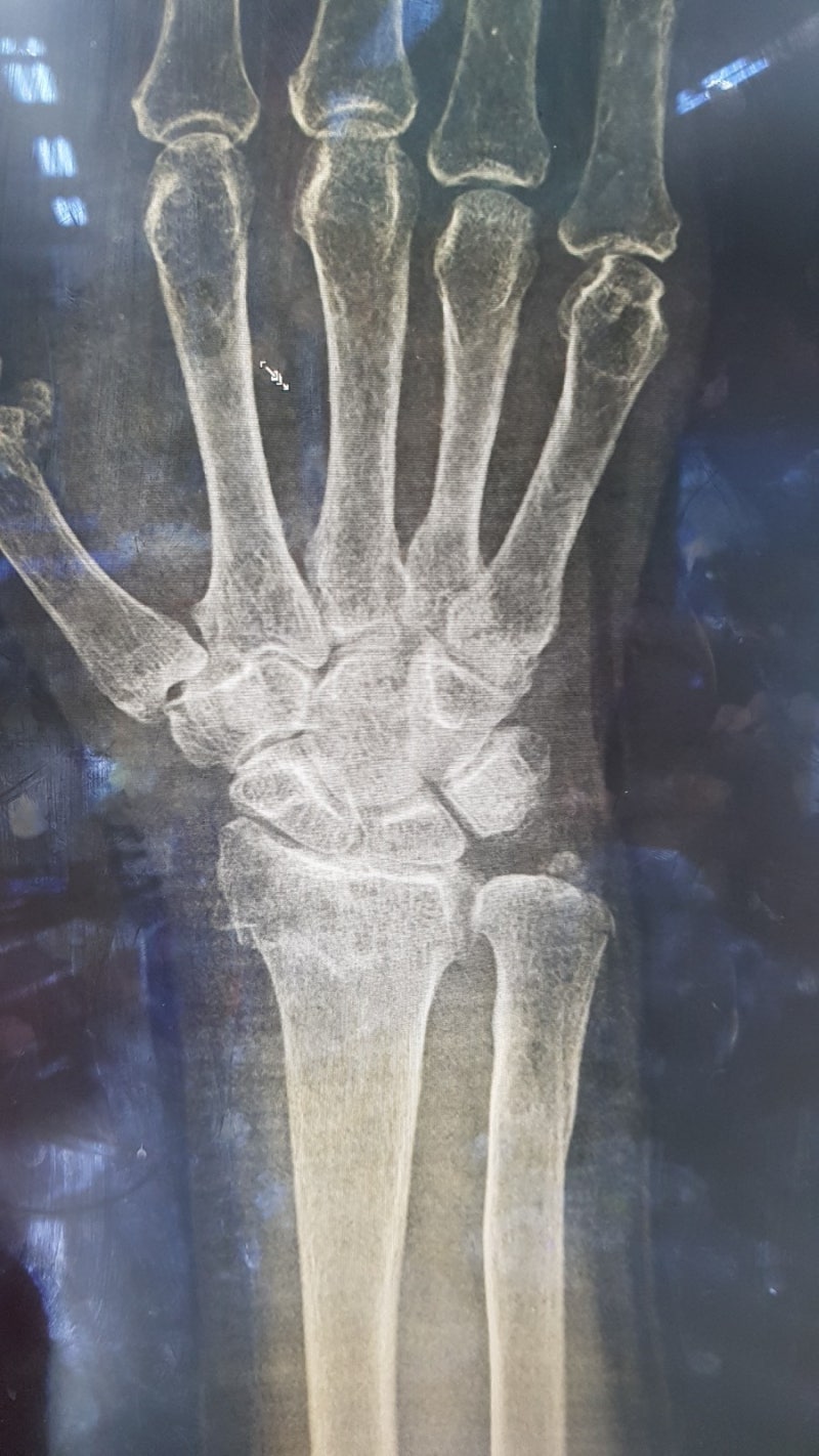 closed reduction of Colles fracture : 네이버 블로그