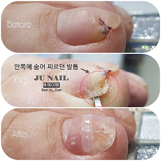 안동에서/분당용인수원성남동백수지보정죽전동/주네일/파고드는발톱 안동에서/분당용인수원성남동백수지보정죽전동/주네일/파고드는발톱