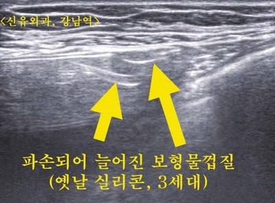 캐나다에서 오신 파손된 옛날실리콘가슴보형물제거수술후기