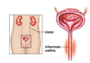 남자요도염 증상 : 비임균성/임균성 나누어 살펴보기 : 네이버 블로그